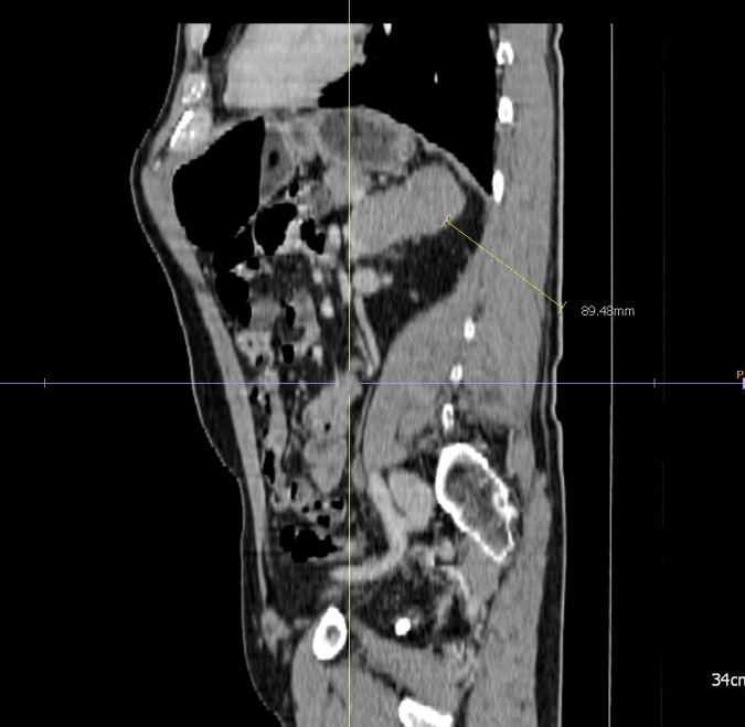 Sagittal view adrenal metastasis